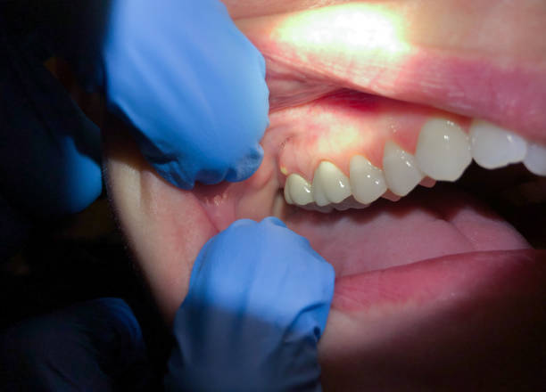 Best Teeth Whitening  in Minorca, LA